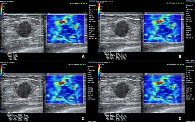 Comprehensive Risk System Based on Shear Wave Elastography and BI-RADS Categories in Assessing Axillary Lymph Node Metastasis of Invasive Breast Cancer—A Multicenter Study